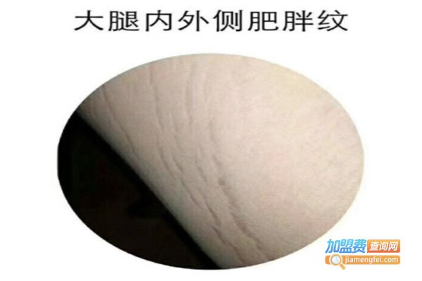 《孕无纹国际加盟费》